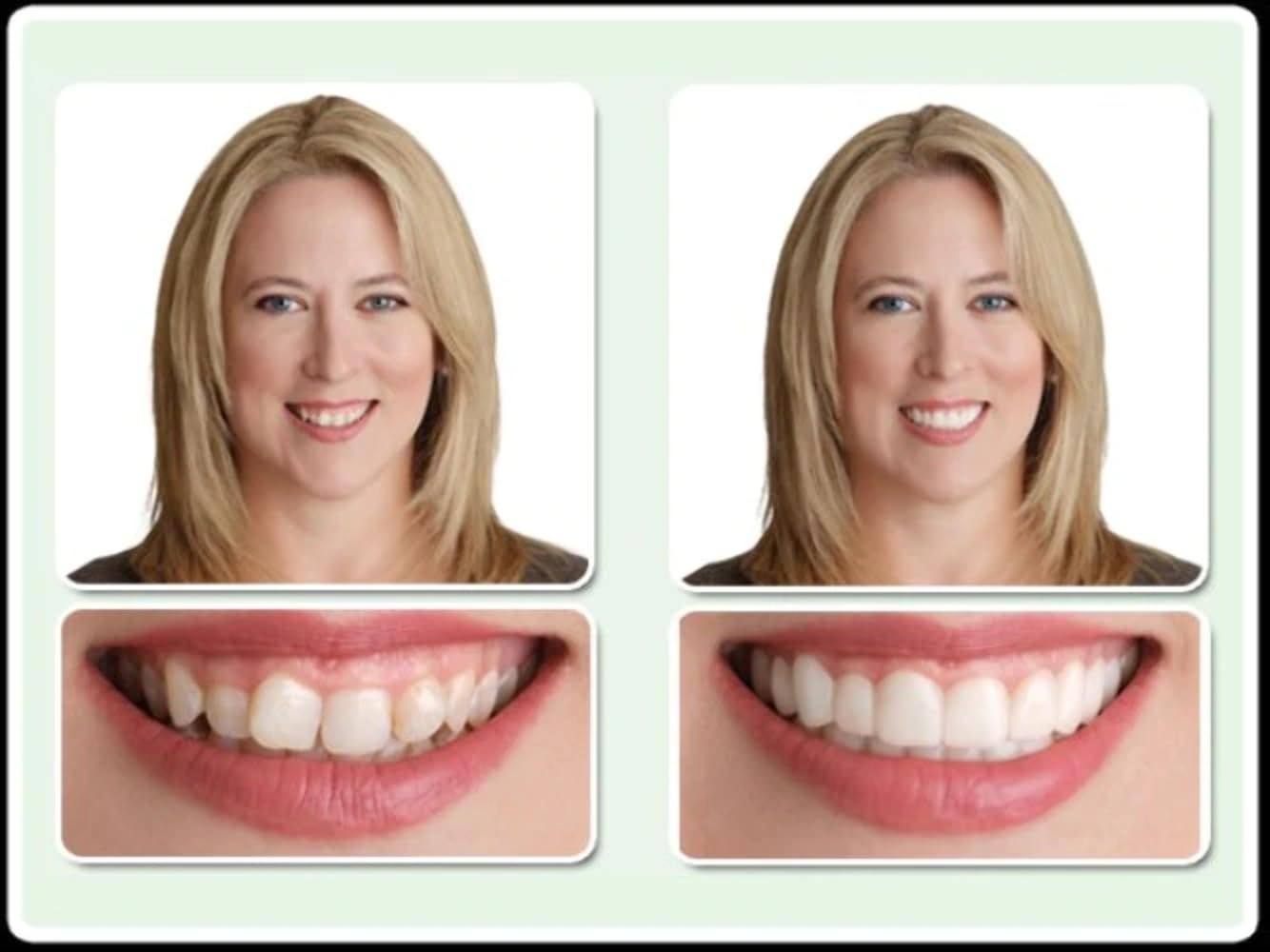 Teeth Upper Veneers For intermittent use only view 5